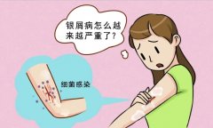 银屑病全解析：揭开这个“皮肤之谜”的面纱！